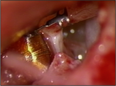soundbridge surgery